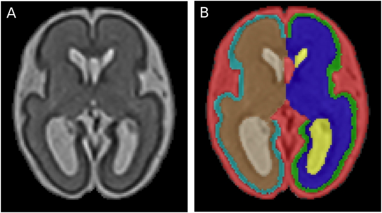 Figura 2 de l'estudi, a l'esquerra (A) imatge real d'un cervell de fetus de 26 setmanes amb ventriculomegàlia, obtinguda per resonància magnètica, i l'esquerra (B) imatge segmentada obtinguda de la real.