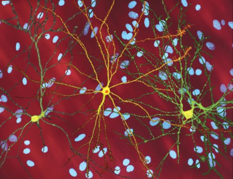 Neuron with HTT gene. https://commons.wikimedia.org/wiki/File:Neuron_with_mHtt_inclusion.jpg Imatge inicial - Neuron with HTT gene. https://commons.wikimedia.org/wiki/File:Neuron_with_mHtt_inclusion.jpg