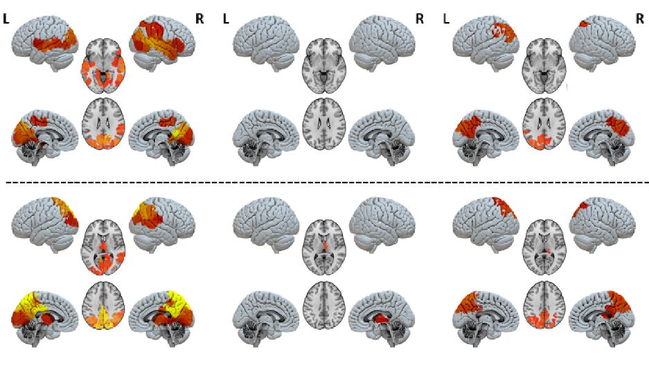 Diferencias en la respuesta de los circuitos cerebrales al transmitir (fila superior) o recibir señales (fila inferior). Izquierda: grupo de control de personas sanas; Medio: síndrome de vigilia sin respuesta (anteriormente conocido como estado vegetativo); Derecha: estado de conciencia mínima. 