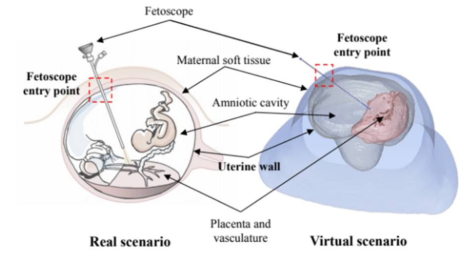 An automatic method to detect and segment the intrauterine cavity based on deep learning