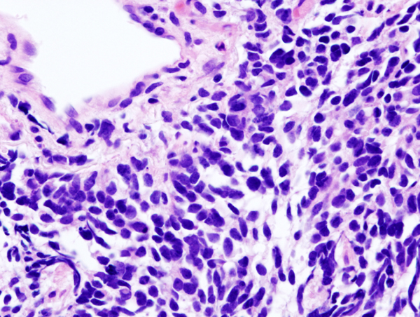 Carcinoma de cèl·lules petites de pulmó - Wikimedia Commons
